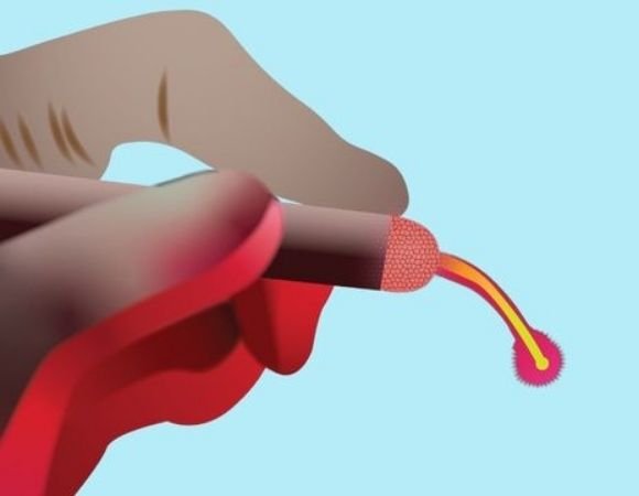 Laser piles surgery Vadodara Dr Samir Contractor