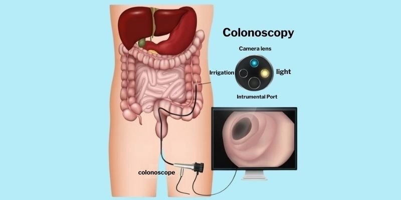 Doctor performing Colonoscopy