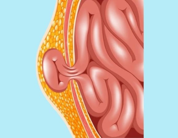 Laparoscopic Hernia Surgery Treatment