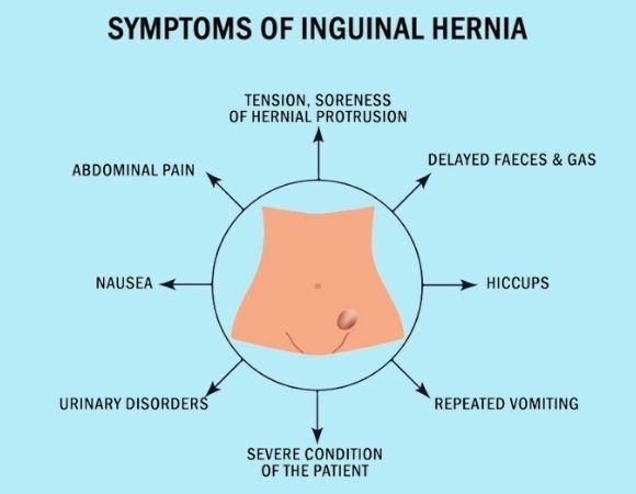 Hernia Symptoms
