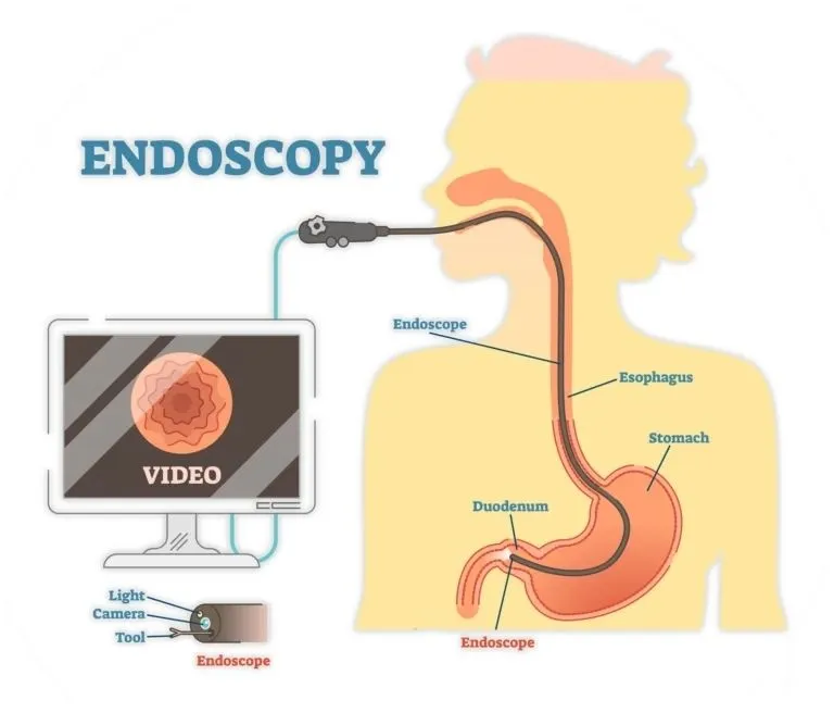 UGI Endoscopy