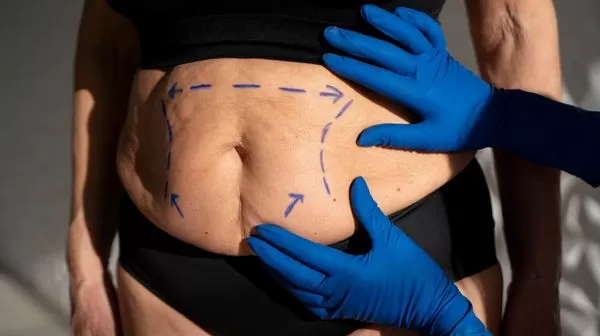 Bariatric Surgery: Separating Safety Myths from Medical Reality