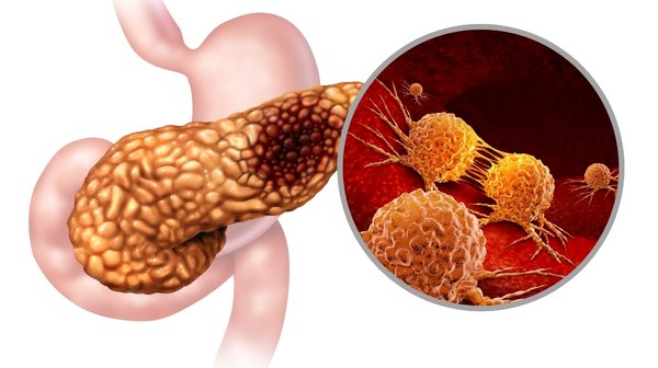 Gallstone Pancreatitis | Symptoms, Causes & Treatment