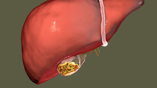 Gallstones | Symptoms, Causes, Diagnosis & Treatment
