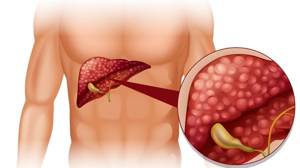 Common Bile Duct Stones (Choledocholithiasis) | Symptoms & Treatment