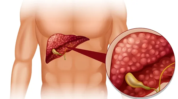Common Bile Duct Stones (Choledocholithiasis) | Symptoms & Treatment